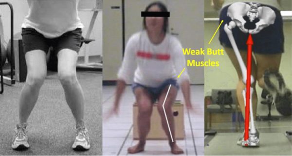 weak butt muscles and valgus knee