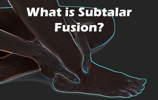 Subtalar Fusion? Do You Really Need This Surgery? - Regenexx