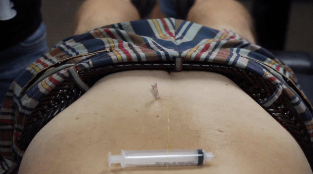 fake intrathecal injection dr harris brimhall wellness