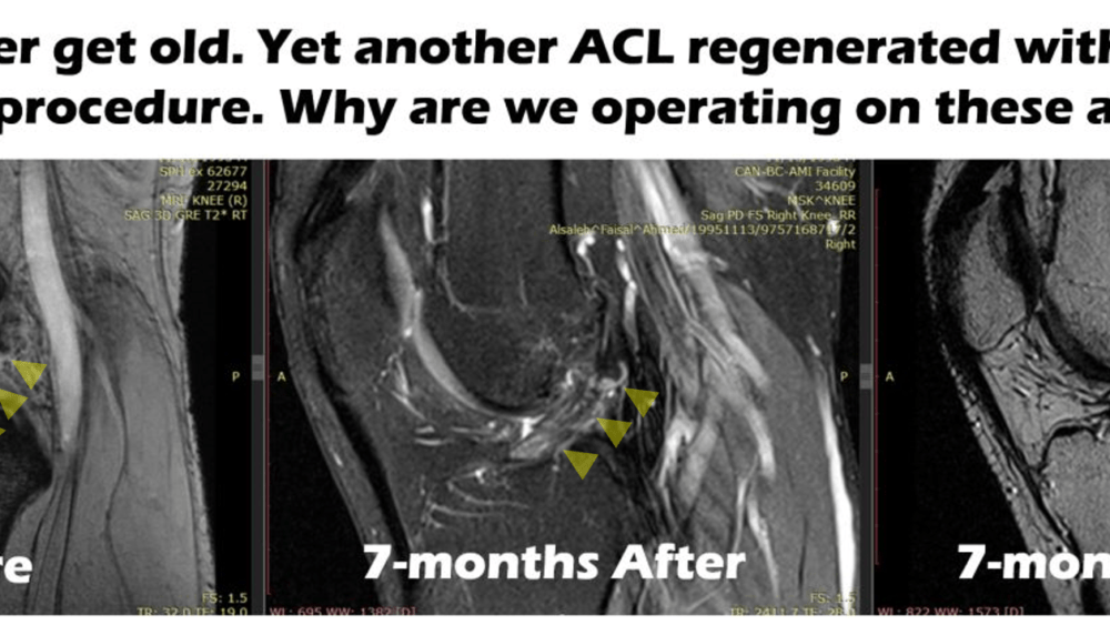 The Latest ACL Regeneration Result