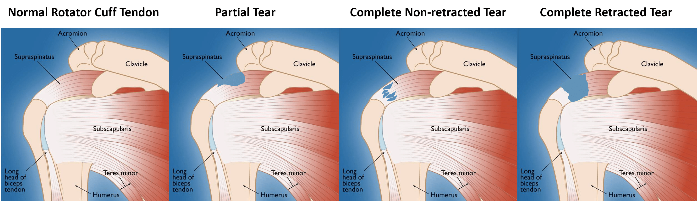 Rotator Cuffs: Tears, Injury Tests, Physical Therapy and Rotator Cuff  Surgery