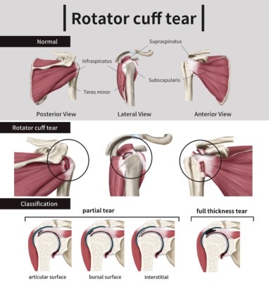 Medical infographic showing a three views of a healthy rotator cuff and the various stages of a tear