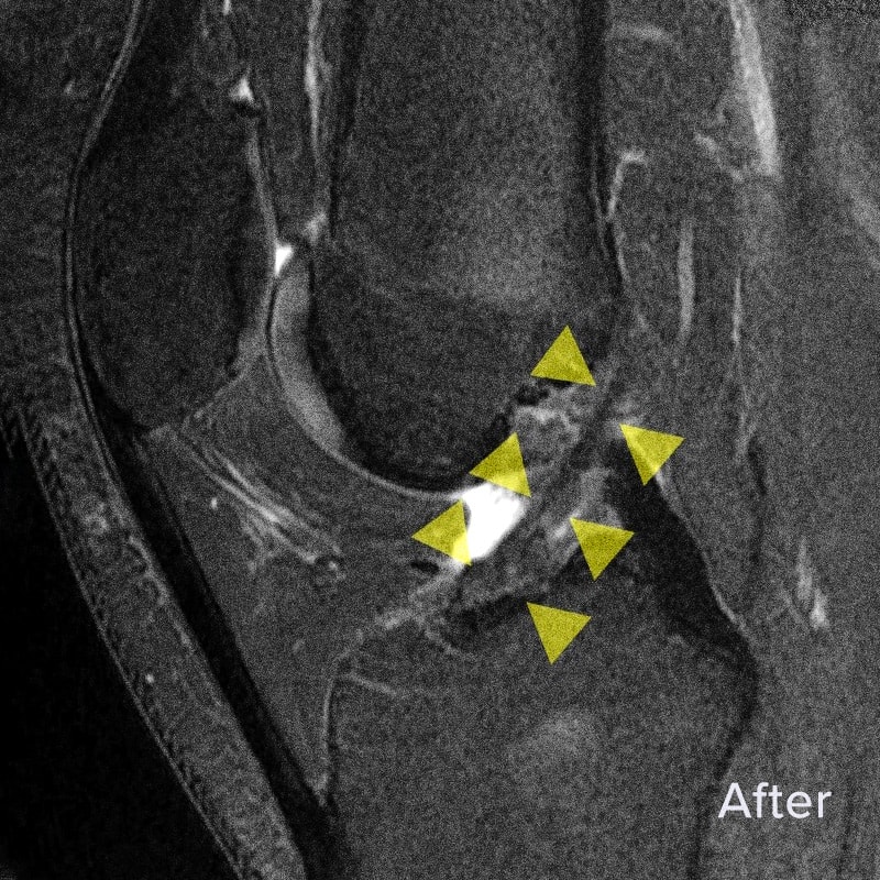 ACL Tear Repair Without Surgery Regenexx