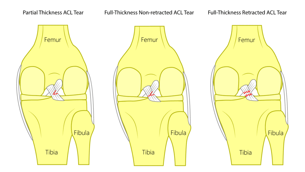 Different types of ACL tears