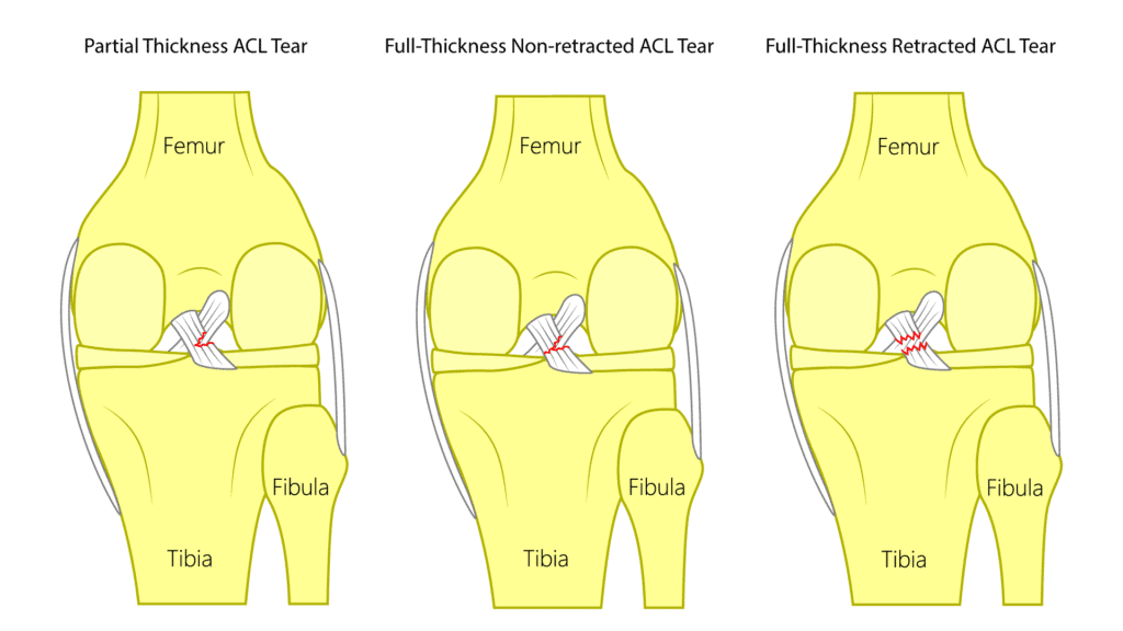 Long term symptoms of ACL tear (without surgery)