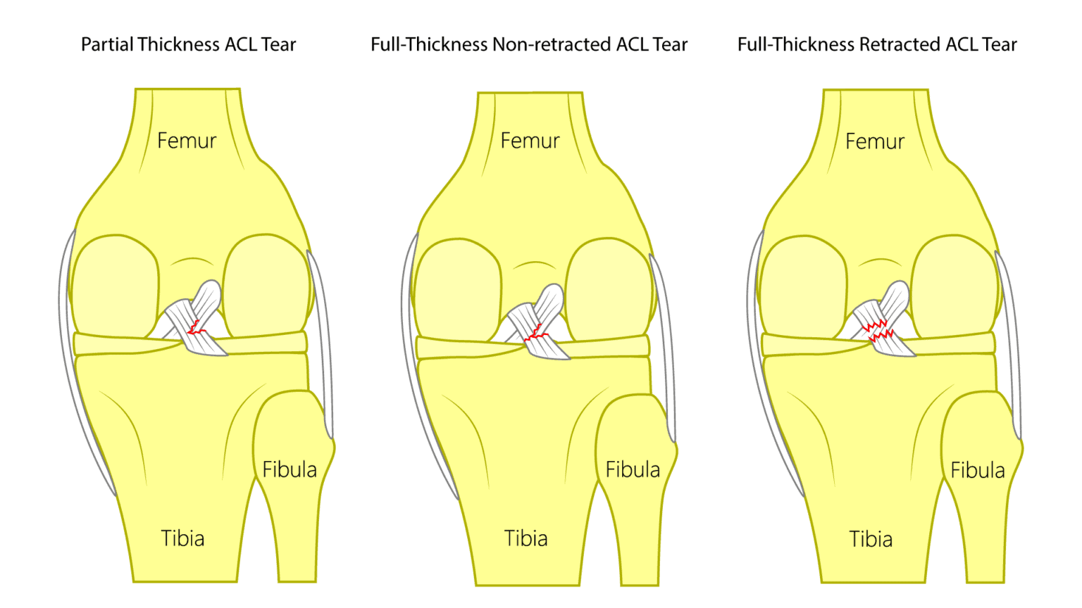 ACL Tear Repair Without Surgery - Regenexx