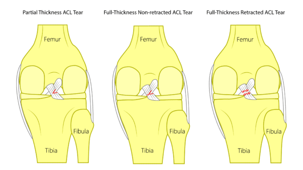 ACL Tear Repair Without Surgery - Regenexx