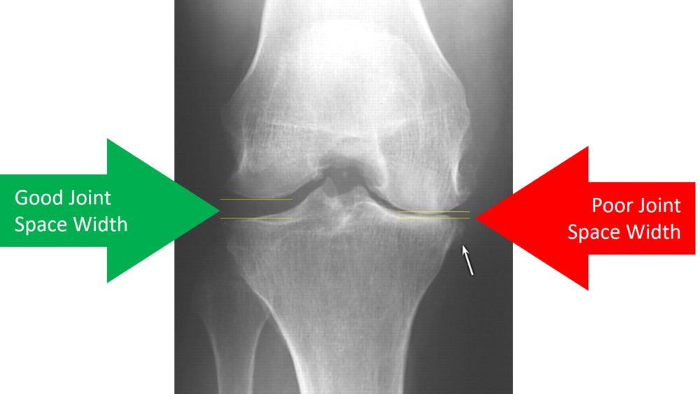 Does a Knee Surgery Help Grow Cartilage? Maybe? No? - Regenexx