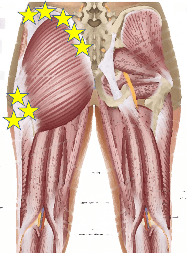 Pain After Hip Replacement Is It Your Tendons Regenexx