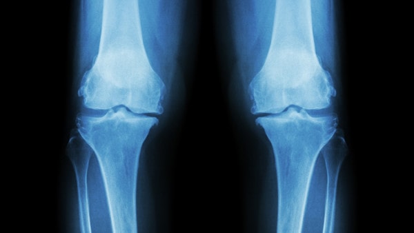 X-ray of both knees showing a loss of cartilage in the joint