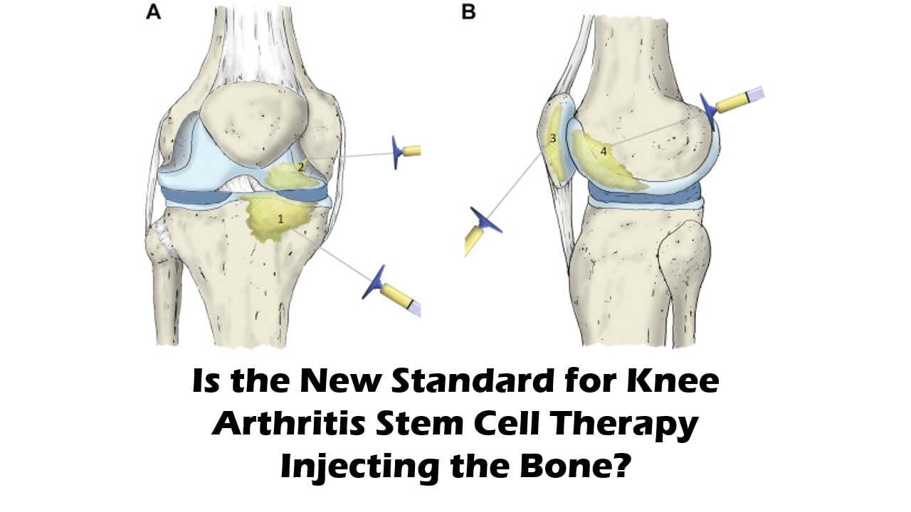 Is Injecting The Bone In Knee Arthritis The New Standard? - Regenexx