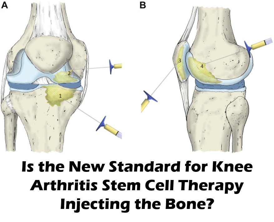 Is Injecting The Bone In Knee Arthritis The New Standard? - Regenexx