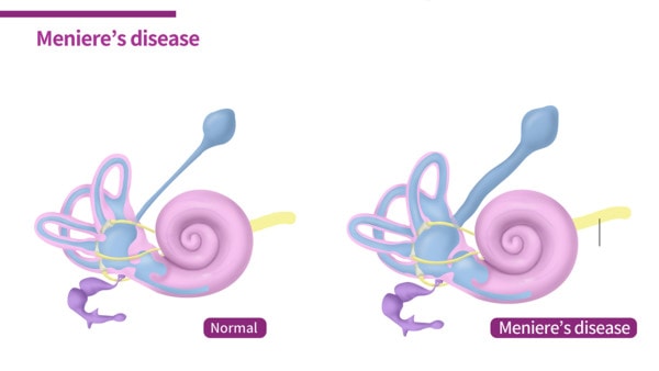 Medical illustration showing the inner ear affected by Meniere’s disease