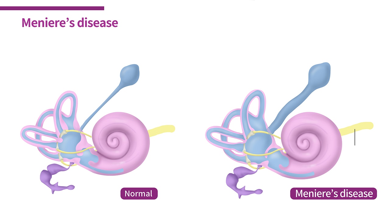 Meniere's Disease and Stem Cells Regenexx