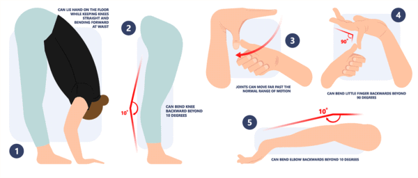 Illustration of various ways to test hypermobility