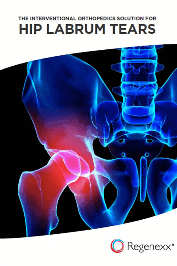 The Interventional Orthopedics Solution For Hip Labrum Tears