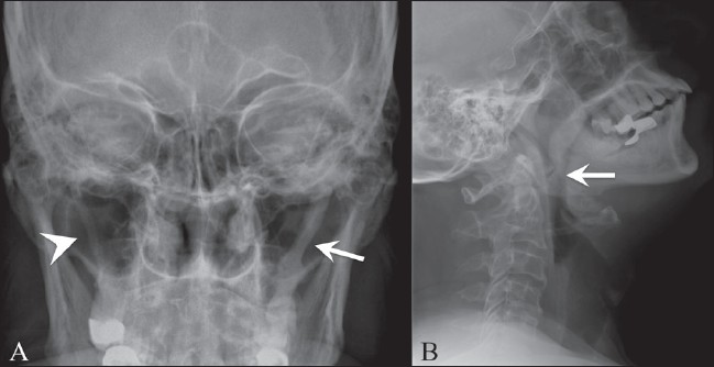 eagle syndrome diagnosis