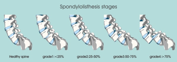 Medical illustration showing the stages of spondylolisthesis