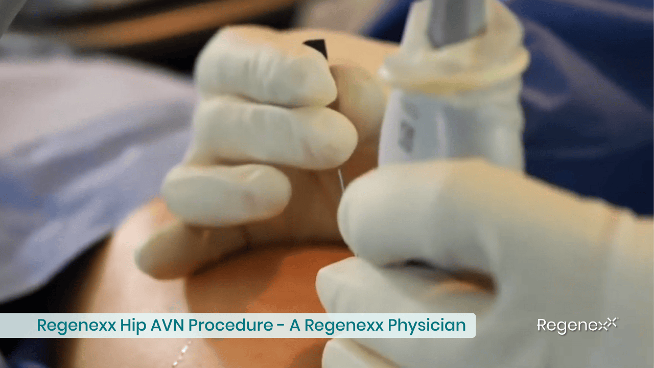 Hip Avascular Necrosis Regenexx Procedure