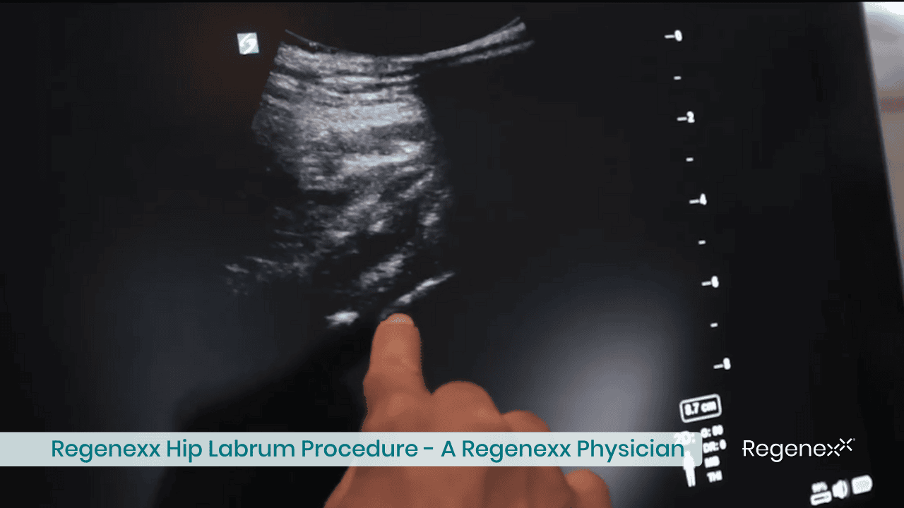 Hip Labrum Regenexx Procedure