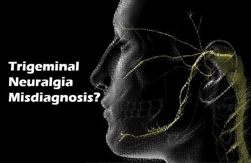 atypical trigeminal neuralgia