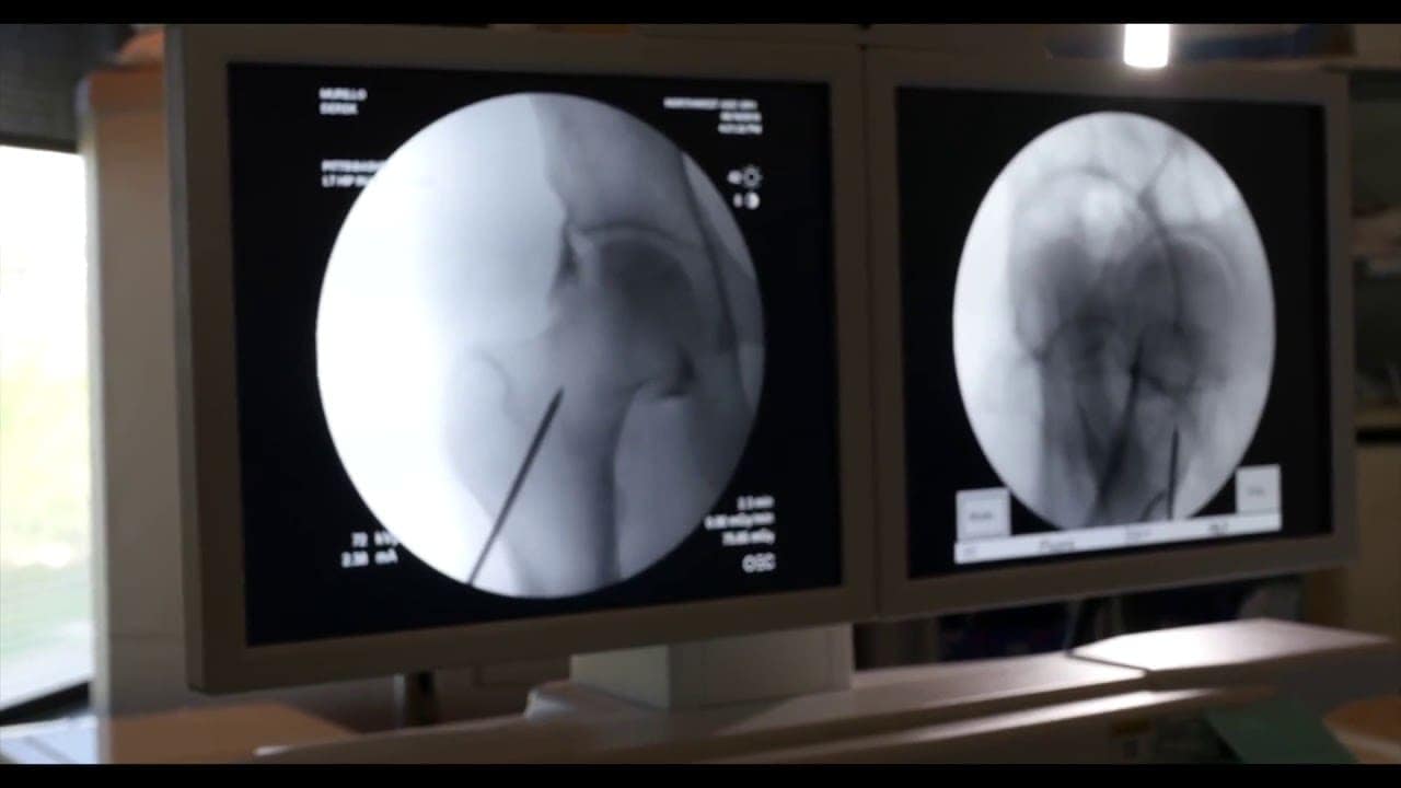 Hip Avascular Necrosis Regenexx Procedure