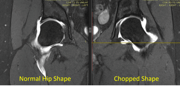 Why Is Hip FAI Common in People Who Have No Hip Pain? - Regenexx