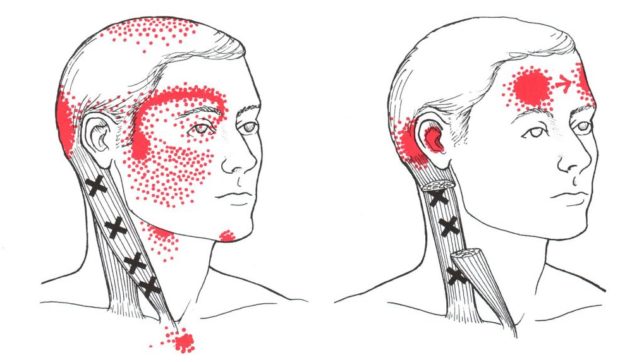 Atypical Trigeminal Neuralgia? - Regenexx