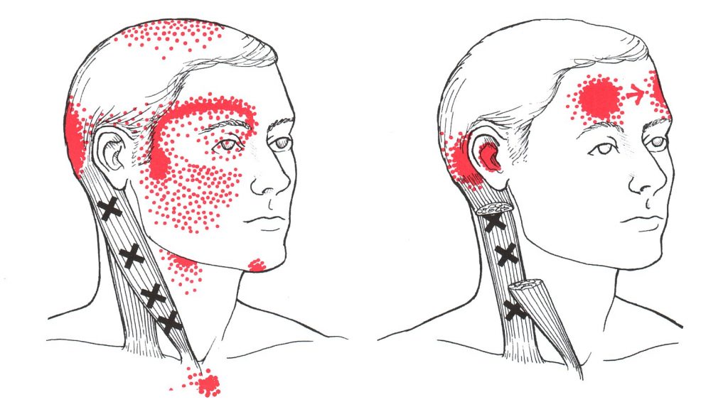 Atypical Trigeminal Neuralgia Regenexx