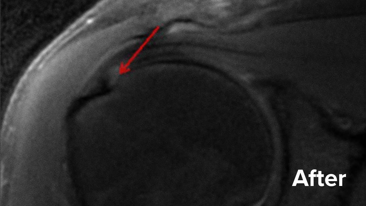 how to read mri images for a torn rotator cuff