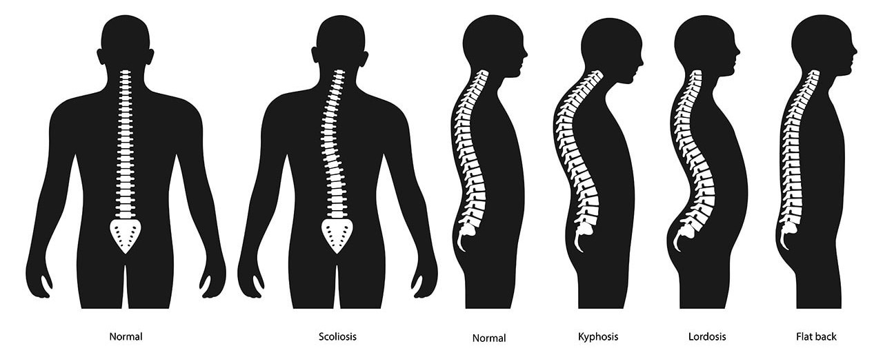 Medical illustration showing various spine conditions including scoliosis and thoracic kyphosis