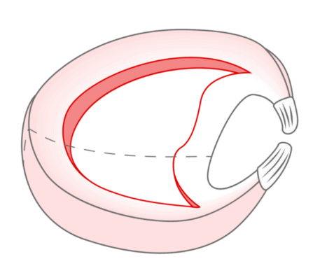 Illustration of bucket handle meniscus tear