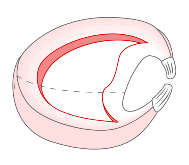 Meniscus Tear Recovery Time Without Surgery | Regenexx