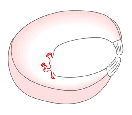 Illustration of degenerative meniscus Tear
