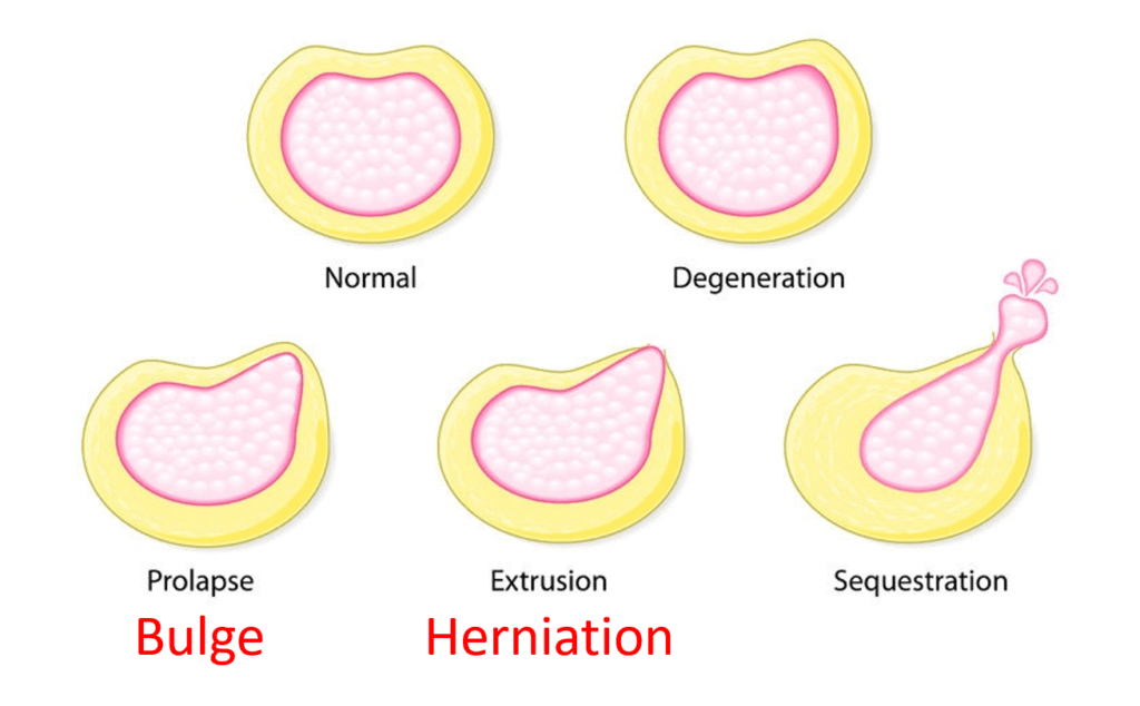 Medical illustration showing the stages to a disc herniation