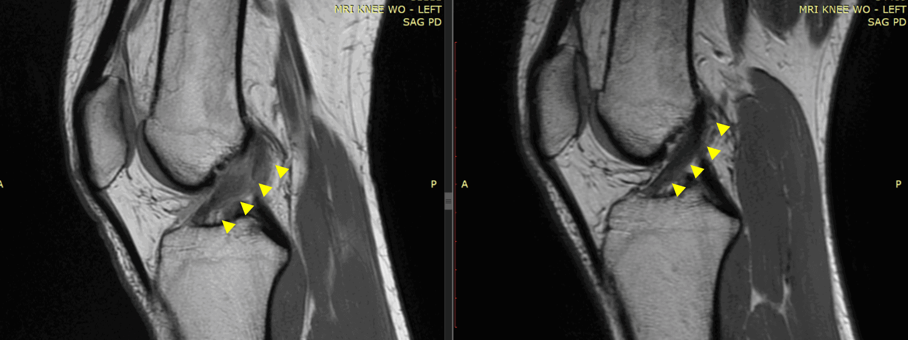 knee acl stem cell treatment