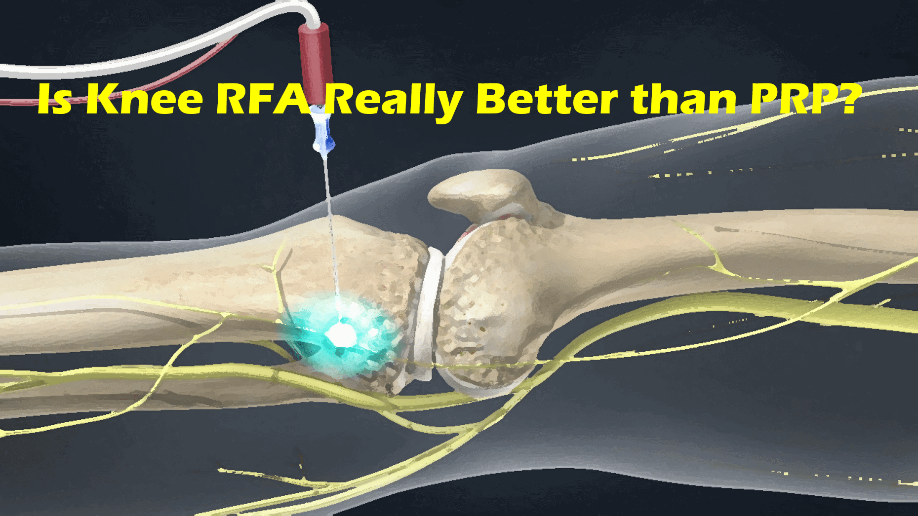 Radiofrequency Ablation Knee