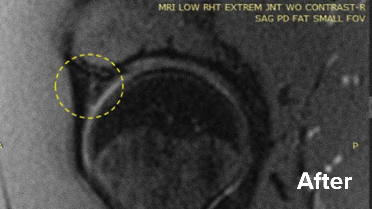 hip-labral-tear-recovery-without-surgery-regenexx