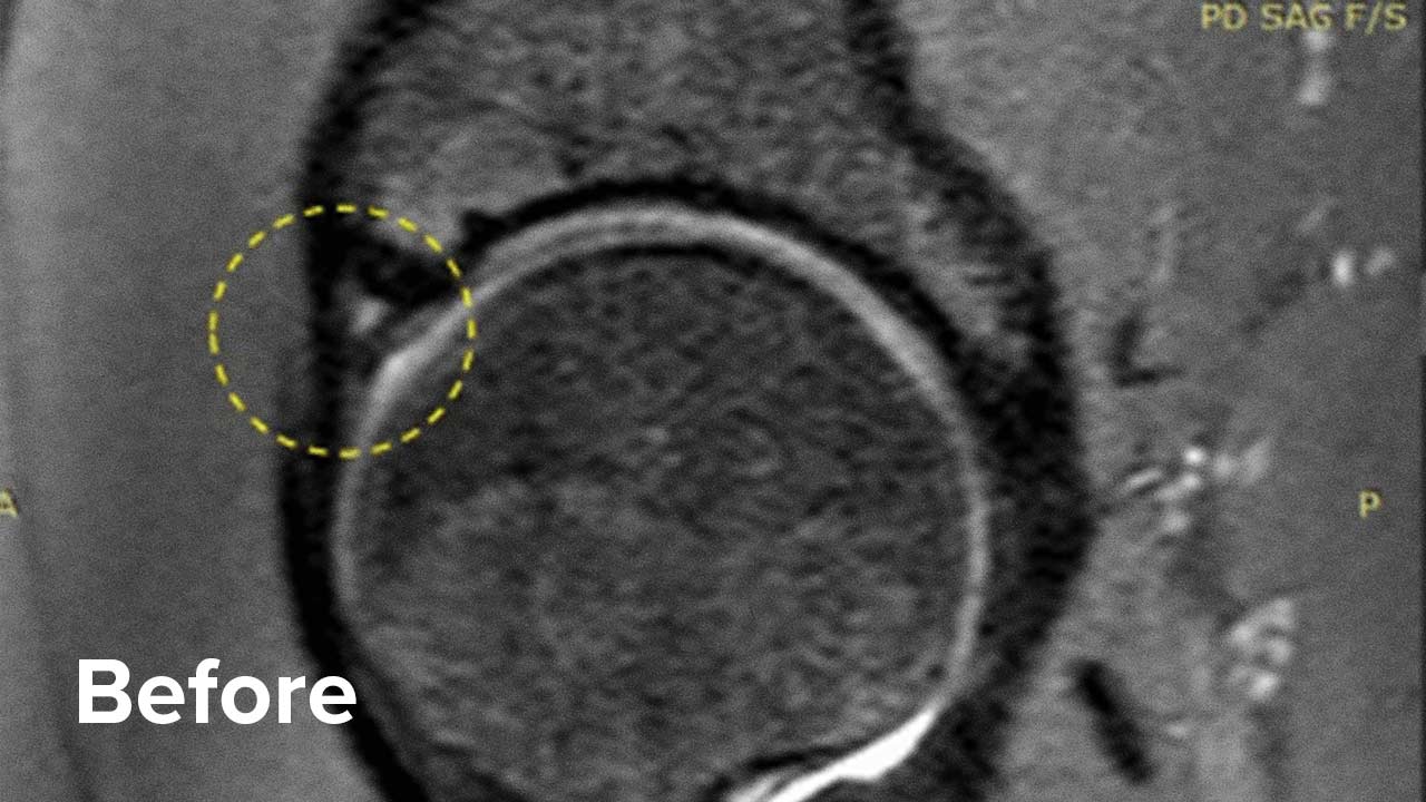 Labral Tear Hip Recovery Without Surgery