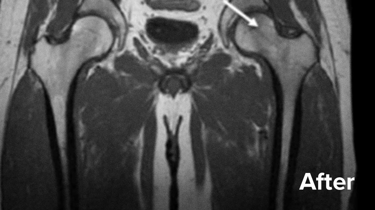 Labral Tear Hip Mri Images