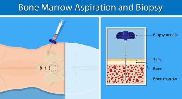 Medical inforgrapic showing a bone marrow aspiration including a close-up of the needle in the bone marrow 