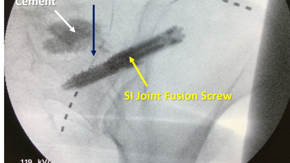 SI Joint Fusion Complications? Why Are We Doing this to Patients?