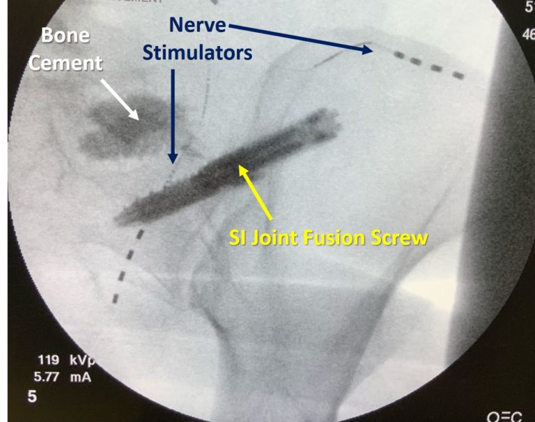 SI Joint Fusion Complications? Why Are We Doing this to Patients ...