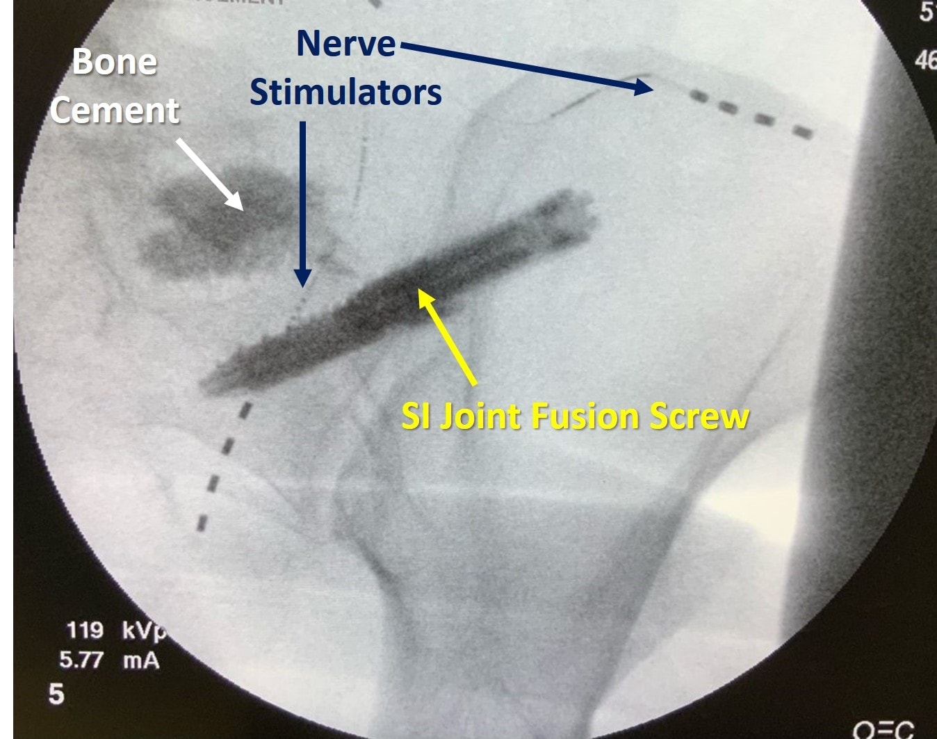 SI Joint Fusion Complications? Why Are We Doing this to