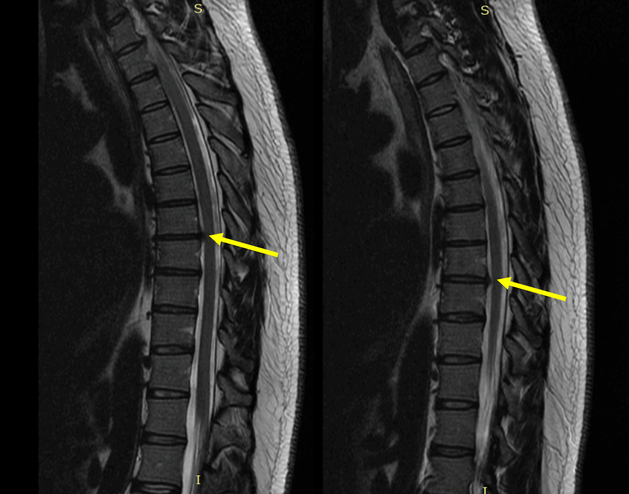What Is Thoracic Radiculopathy? - Regenexx