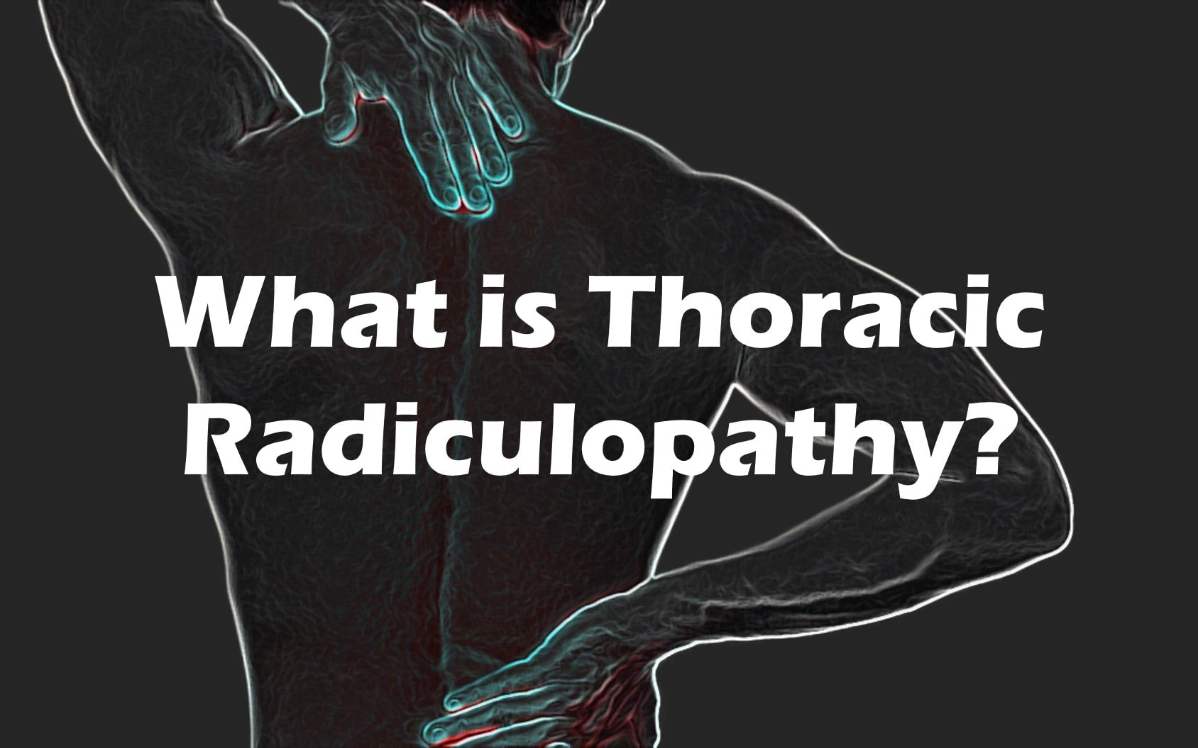 Thoracic Spine Radiculopathy