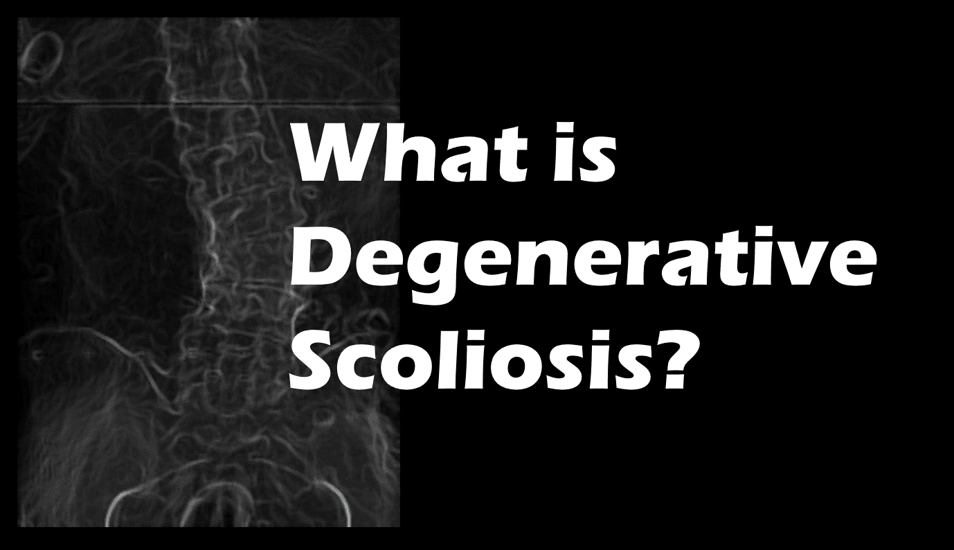 what is degenerative scoliosis