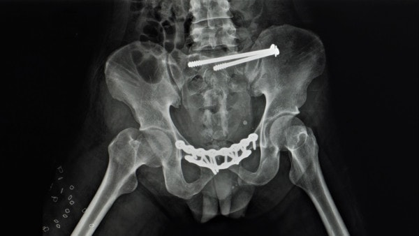X-ray showing the results of a sacroiliac joint fixation with screws visible