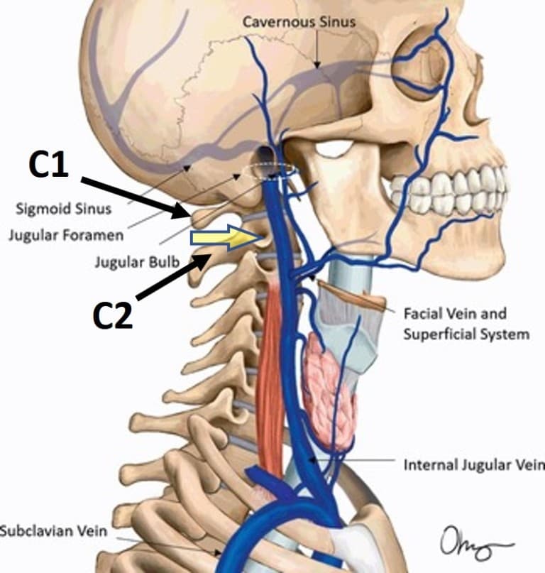 jugular-vein-compression-due-to-the-neck-and-cci-regenexx