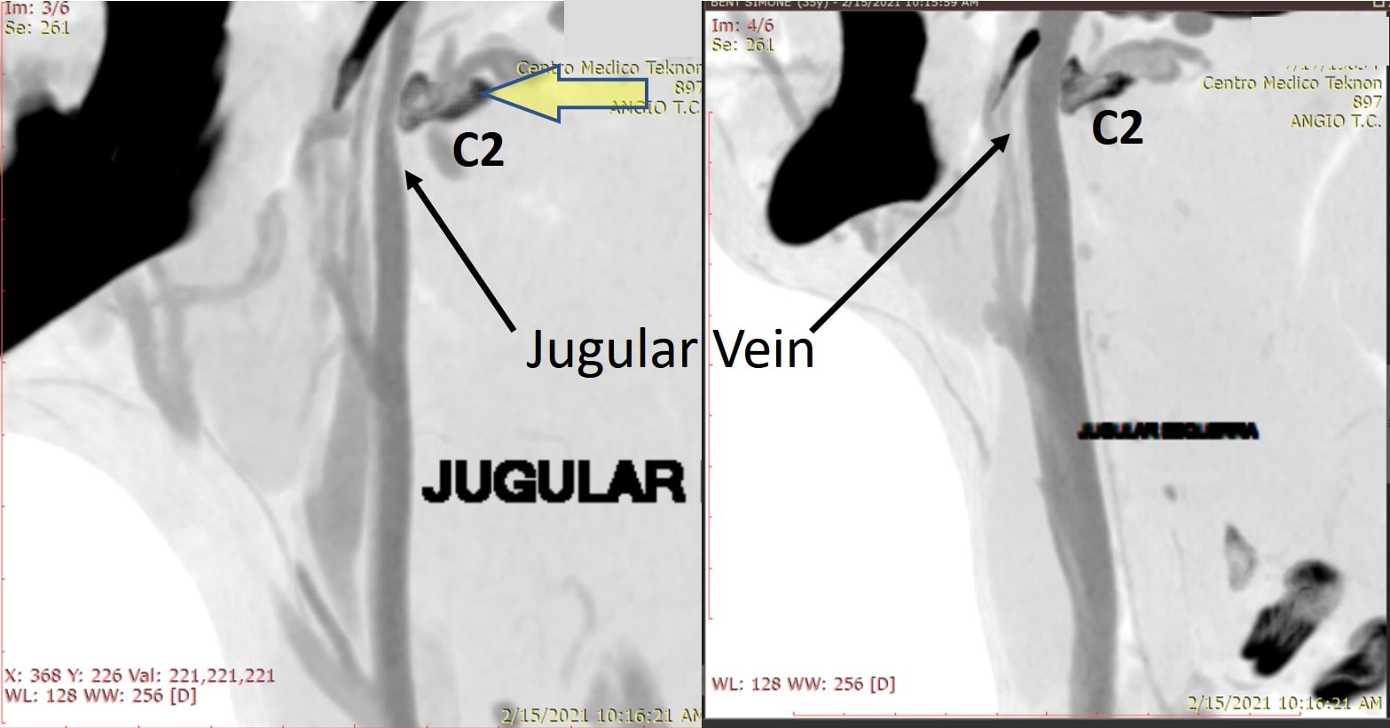 Jugular Vein Compression Due to the Neck and CCI Regenexx